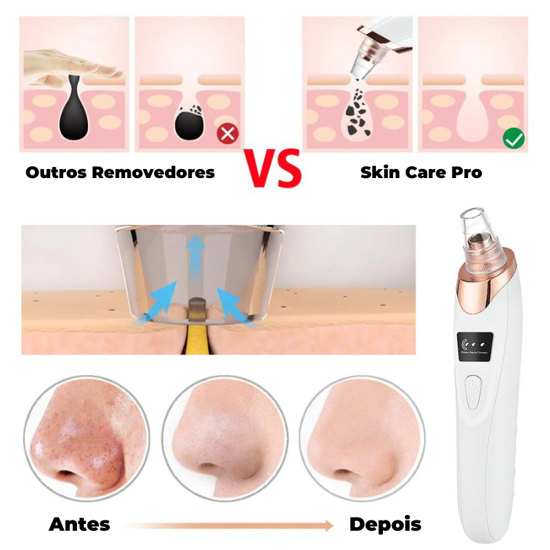 Removedor de Cravos e Espinhas Elétrico Skin Care Pro + Kit Limpeza de Pele
